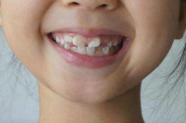 牙齿矫正的最佳时间是什么时候三个年龄段矫正牙齿最佳